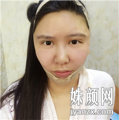 北京炫美医疗美容诊所徐学东全脸脂肪填充+面部吸脂案列恢复图