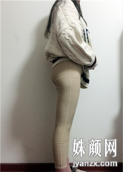 重庆军美医疗美容门诊部大腿收脂+臀线术恢复图
