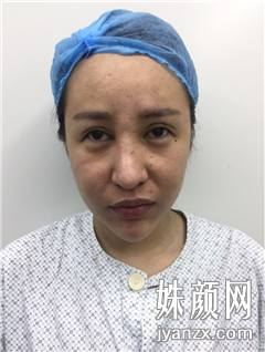 北京叶美人医疗美容诊所 张伟面部吸脂+填充术前图