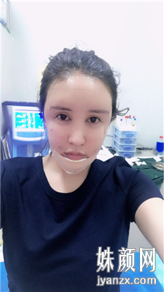 北京叶美人医疗美容诊所 张伟面部吸脂+填充恢复图
