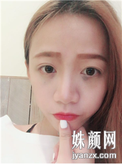 北京叶美人医疗美容诊所 张伟面部吸脂+填充恢复恢复图
