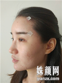 上海百达丽医疗美容门诊部 顾建成自体脂肪填充恢复图