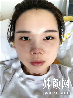 北京叶美人医疗美容诊所 张伟自体脂肪填充恢复图