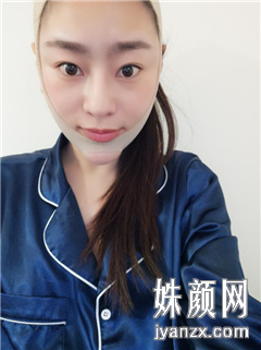 北京叶美人医疗美容诊所张伟面部吸脂案例分享图恢复图