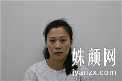 北京叶美人医疗美容诊所张伟自体脂肪术前图