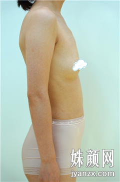 北京欧兰美医疗美容门诊部张艳华自体脂肪丰胸术前图