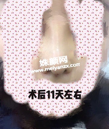 成都西婵绍文辉医生做的硅胶隆鼻➕耳软骨鼻中隔
